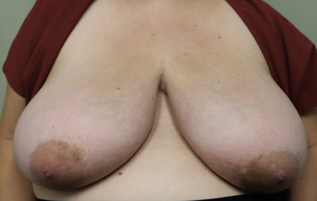 Lymphedema medial quadrants breasts size K